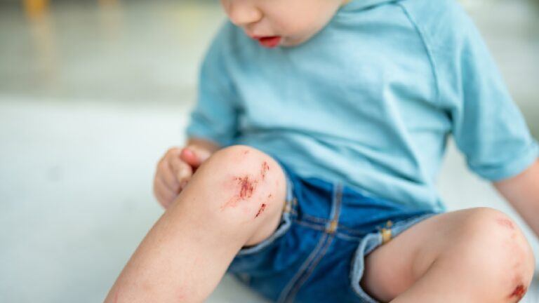 Child with a scraped knee being treated, highlighting the importance of a childcare first aid kit for centres to stay compliant and prepared.